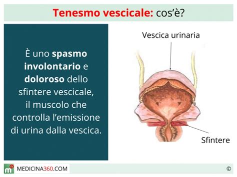 diagramma che illustra il tenesmo vescicale e rettale