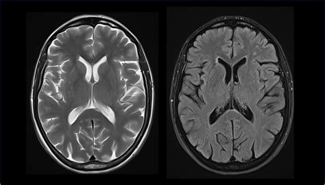 Immagine di una scansione cerebrale RM che evidenzia aree di atrofia cerebrale