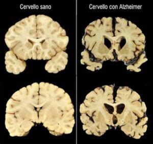 Immagine che mostra un confronto tra un cervello sano e un cervello affetto da demenza