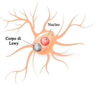 Microscopia di corpi di Lewy