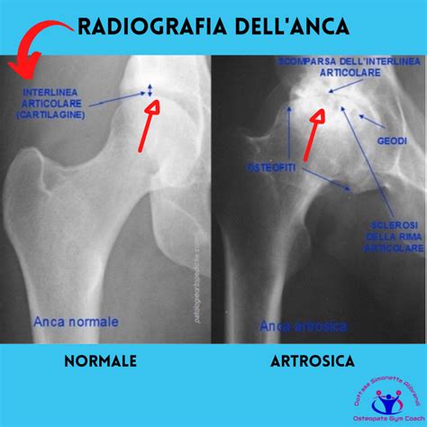 Radiografia di anca con artrosi avanzata