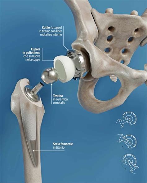 Schema di una protesi d'anca a doppia mobilità