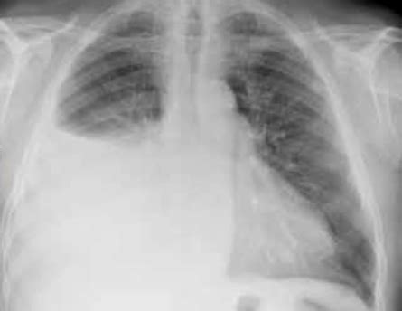 Radiografia del torace che mostra infiltrati alveolo-interstiziali diffusi e effusione pleurica bilaterale