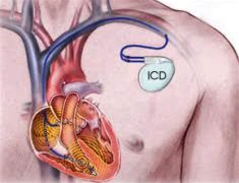 Immagine di un defibrillatore automatico impiantabile (ICD)