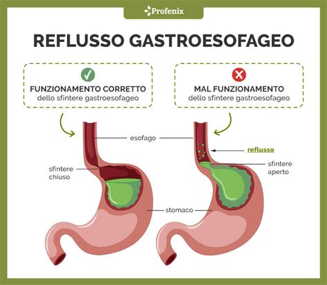Diagramma del reflusso faringo-laringeo