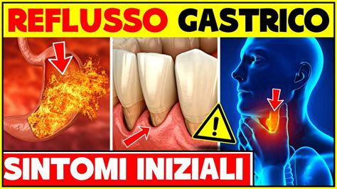Dettaglio di denti erosi a causa dell'acido gastrico