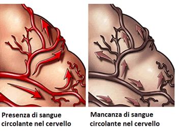 Diagramma che illustra le diverse cause di demenza vascolare