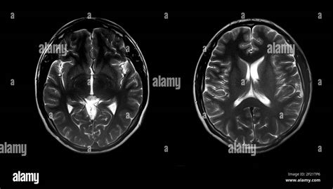 Risonanza Magnetica Cerebrale