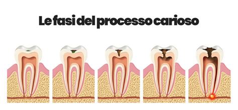 Schema del processo di formazione della carie dentale