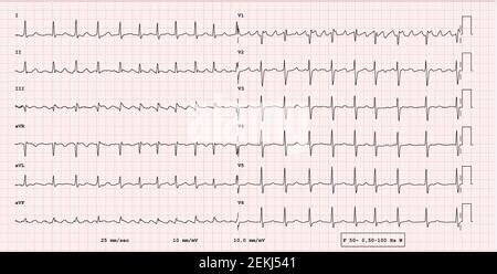 Grafico ECG di fibrillazione atriale