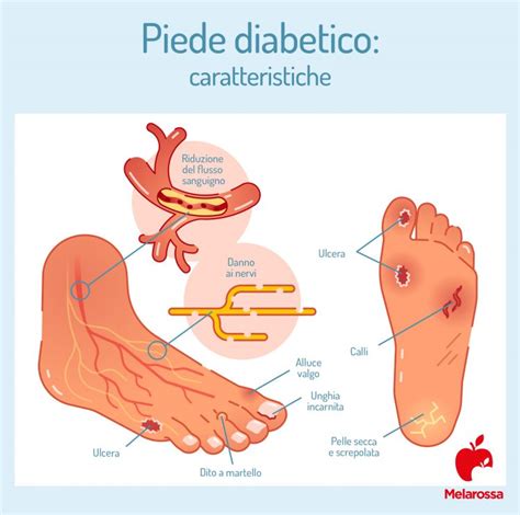 Immagine di un piede sano e un piede diabetico a confronto