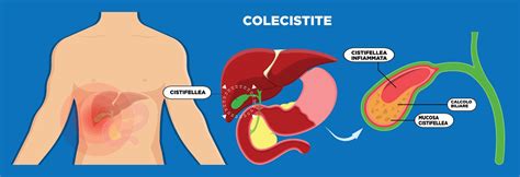 Diagramma che illustra i sintomi della colecistite acuta