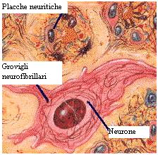 Diagramma che illustra la formazione di placche amiloidi e grovigli tau nel cervello