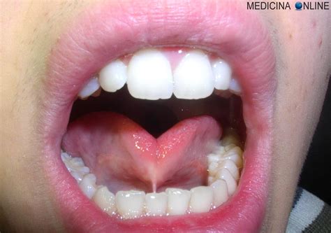 bocca umana con frenulo linguale