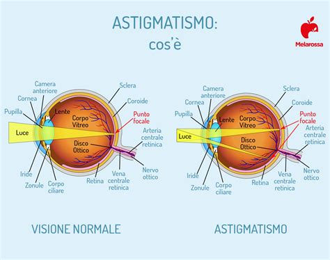 Diagramma dell'occhio con astigmatismo