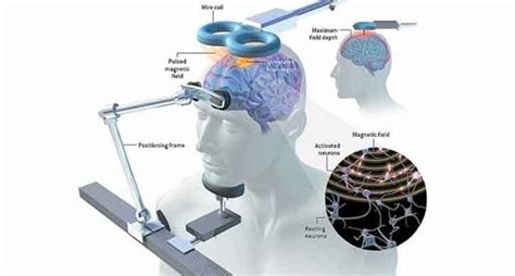 Infografica che confronta la Stimolazione Magnetica Transcranica (TMS) e il Neurofeedback