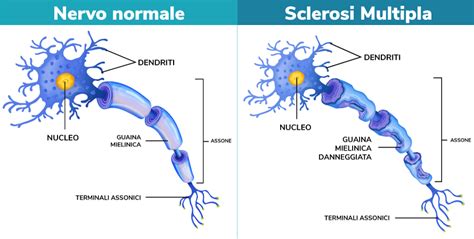 Grafico che mostra la prevalenza della Sclerosi Multipla per genere