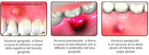 Diagramma di un ascesso dentale