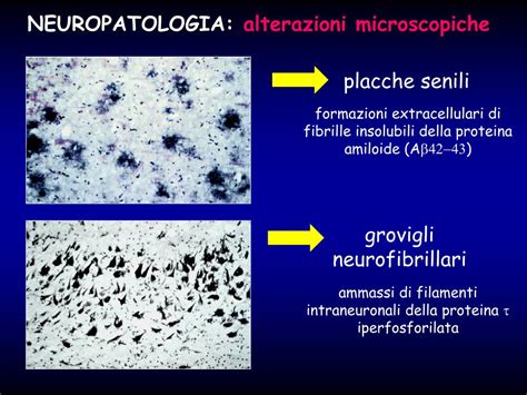 Immagine microscopica che mostra placche amiloidi e grovigli neurofibrillari nel cervello di un paziente con Alzheimer