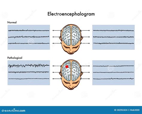 Illustrazione di un elettroencefalogramma (EEG)