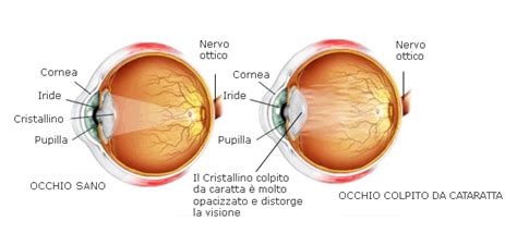 Diagramma dell'occhio umano con il cristallino normale e opacizzato