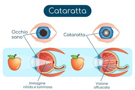 Illustrazione di un occhio post-chirurgia cataratta con lievi arrossamenti