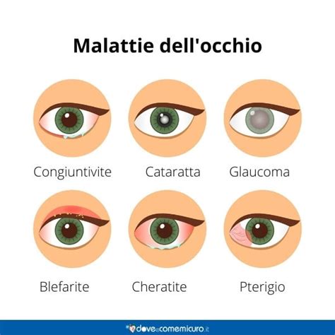 Infografica sui sintomi e le cause dell'occhio secco post-chirurgia cataratta