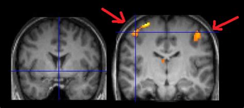 Immagine fMRI che mostra l'attività cerebrale durante un compito cognitivo