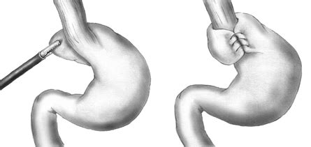 Schema di una fundoplicatio laparoscopica