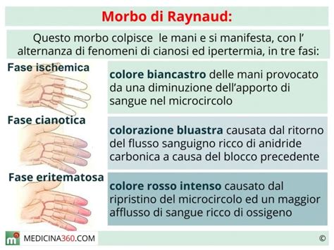 Diagramma delle tre fasi del fenomeno di Raynaud: pallore, cianosi, eritema