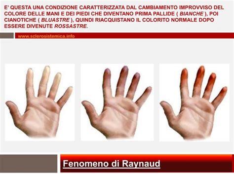 Mappa che mostra la prevalenza del fenomeno di Raynaud in diverse zone geografiche