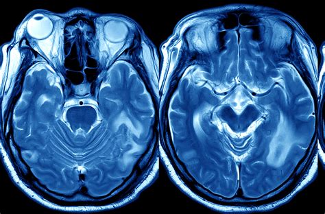 Immagine di una risonanza magnetica cerebrale che mostra aree di infarto