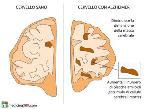 Infografica che illustra il processo della cascata amiloidea nella malattia di Alzheimer