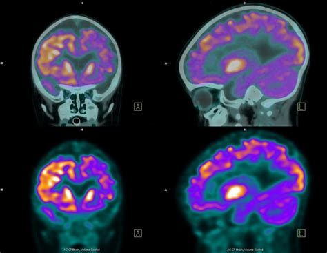 Immagine di una scansione cerebrale PET o fMRI