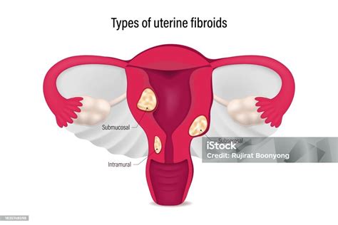 Diagramma dell'utero che mostra i diversi tipi di fibromi