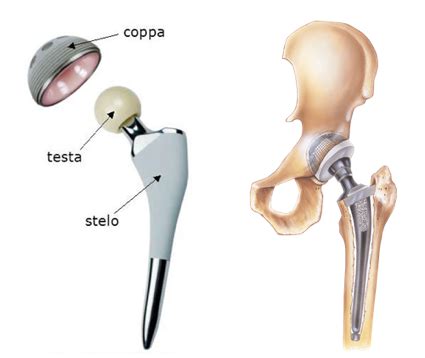 Componenti di una protesi totale d'anca