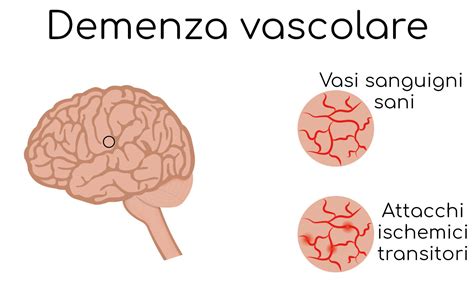 Diagramma che illustra i diversi tipi di demenza vascolare e le aree cerebrali colpite
