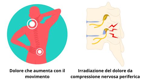 Illustrazione che mostra le diverse direzioni di irradiazione del dolore cervicale.