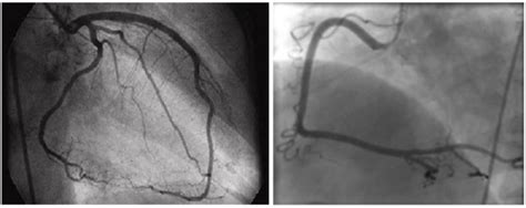 Immagine di un catetere che avanza verso le arterie coronarie