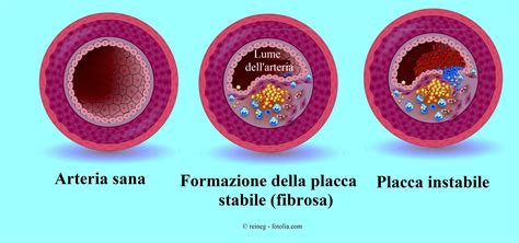 Diagramma che mostra la formazione di placche aterosclerotiche nelle arterie