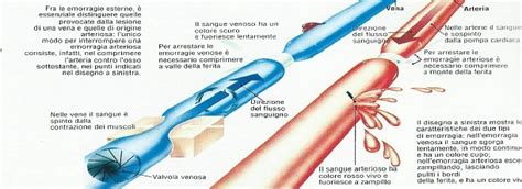 Schema che mostra la classificazione delle emorragie intraventricolari secondo Papile