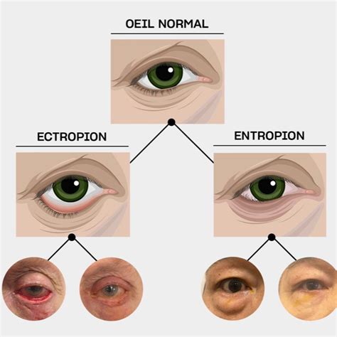 Schema comparativo di Entropion ed Ectropion