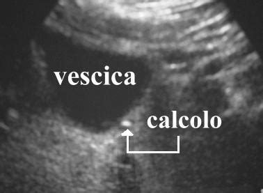 Complicanze dell'IPB: Ristagno urinario e calcoli vescicali