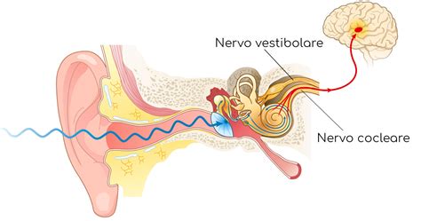 Diagramma che illustra l'infiammazione del nervo vestibolare