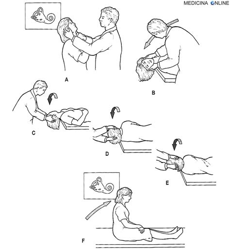Schema della manovra di Dix-Hallpike