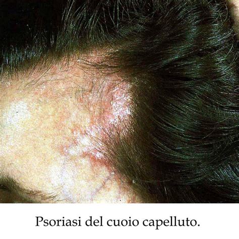 cuoio capelluto con chiazze di alopecia