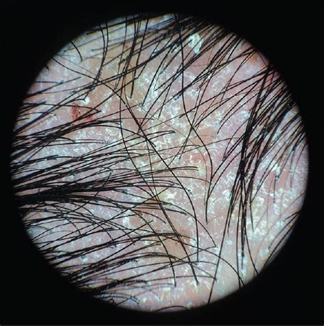 immagini di varie condizioni del cuoio capelluto, come dermatite seborroica e follicolite