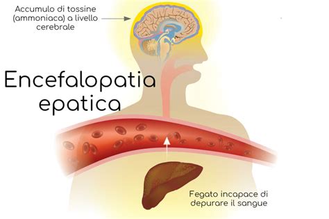 Illustrazione che mostra i diversi stadi dell'encefalopatia epatica con sintomi correlati