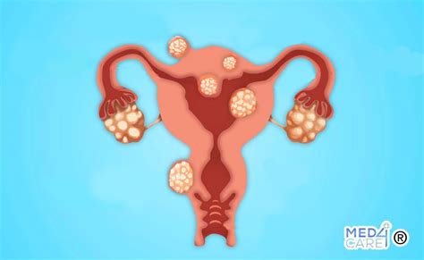 Struttura dell'utero con fibromi