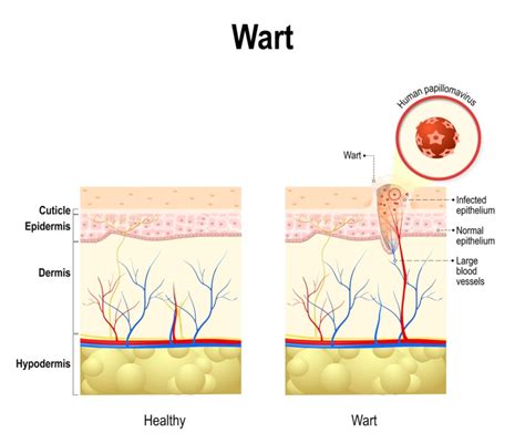 Grafico che mostra la riduzione dell'incidenza delle verruche genitali e delle lesioni precancerose dopo l'introduzione della vaccinazione HPV in Australia